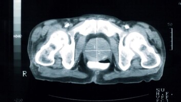 En scan av en hofte viser en prostata rammet av kreft (hvitt kryss i midten). Prostata er her nesten tre ganger større enn normalt. (Foto: Istockphoto) En scan av en hofte viser en prostata rammet av kreft (hvitt kryss i midten). Prostata er her nesten tre ganger større enn normalt. (Foto: Istockphoto)
