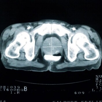 En scan av en hofte viser en prostata rammet av kreft (hvitt kryss i midten). Prostata er her nesten tre ganger større enn normalt. (Foto: Istockphoto)