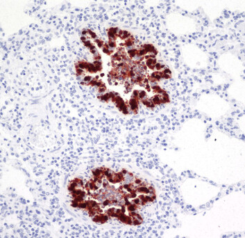 Snitt fra lungevev fra gris angrepet av influensa A (H1N1) 2009 (mørke figurer). (Foto: Mette Valheim) Snitt fra lungevev fra gris angrepet av influensa A (H1N1) 2009 (mørke figurer). (Foto: Mette Valheim)