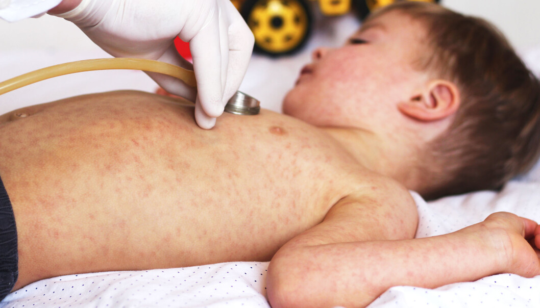 Barn som fikk meslinger, fikk immunsystemet kraftig svekket mot andre sykdommer som de var immune mot på forhånd. Barn som fikk meslinger, fikk immunsystemet kraftig svekket mot andre sykdommer som de var immune mot på forhånd.