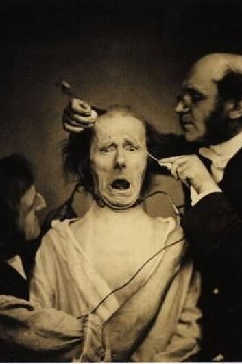 Guillaume Duchenne de Boulogne (1806–1875) var en fransk nevrolog som undersøkte følelsenes fysiologi i det store verket «Mécanisme de la physionomie humaine», som blant annet inspirerte Darwin. Ved hjelp av små støt utløste han ansiktsuttrykk, som ble fotografert. Her er han i ferd å sette strøm i yndlingsmodellen sin. (Foto: Duchenne de Boulogne/Wikimedia Commons) Guillaume Duchenne de Boulogne (1806–1875) var en fransk nevrolog som undersøkte følelsenes fysiologi i det store verket «Mécanisme de la physionomie humaine», som blant annet inspirerte Darwin. Ved hjelp av små støt utløste han ansiktsuttrykk, som ble fotografert. Her er han i ferd å sette strøm i yndlingsmodellen sin. (Foto: Duchenne de Boulogne/Wikimedia Commons)