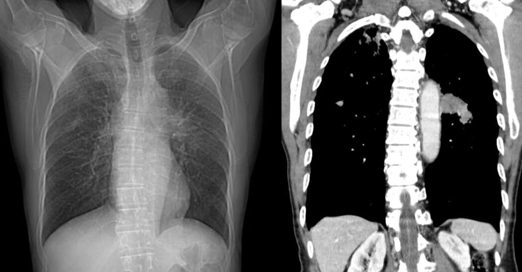 Bildet viser CT-scanning som viser lungekreft. CT er tverrsnitt-fotografering av et utvalgt område av kroppen med røntgenstråler. Bildet viser CT-scanning som viser lungekreft. CT er tverrsnitt-fotografering av et utvalgt område av kroppen med røntgenstråler.