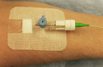 En probe med den optiske fiberen legges inn i blodåren. Fiberen er ikke tykkere enn et hårstrå. Med en forsinkelse på kun ett til to minutter vil måleinstrumentet gjøre kontinuerlige målinger av blodsukkernivået. Måleinstrumentet er under uttesting. (Foto: Invivosense) En probe med den optiske fiberen legges inn i blodåren. Fiberen er ikke tykkere enn et hårstrå. Med en forsinkelse på kun ett til to minutter vil måleinstrumentet gjøre kontinuerlige målinger av blodsukkernivået. Måleinstrumentet er under uttesting. (Foto: Invivosense)