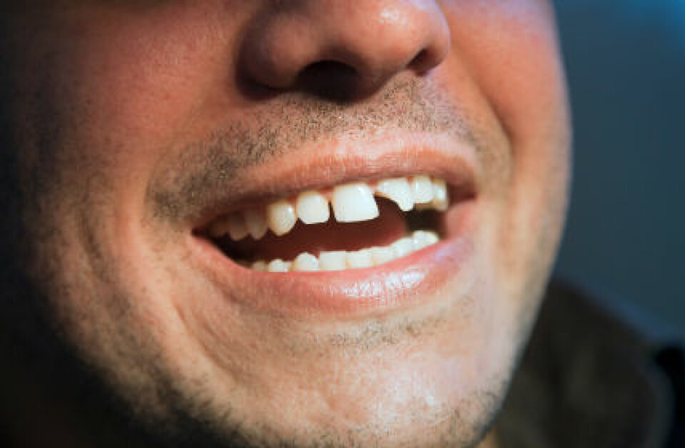 Levekårundersøkinga syner blant anna at det særleg er dei med dårleg eigenvurdert tannhelse som har eit udekt tannlegebehov. (Foto: iStockphoto)