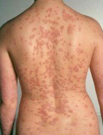"Psoriasis" "Psoriasis"