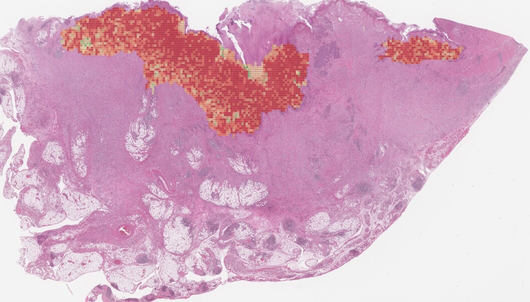 From thousands of images, artificial intelligence draws conclusions about the prognosis of each individual tumor. From thousands of images, artificial intelligence draws conclusions about the prognosis of each individual tumor.