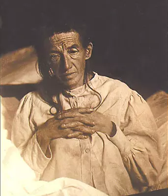 Auguste Deter’s family gave the psychiatrist Alois Alzheimer permission to autopsy Deter’s brain. This allowed Dr Alzheimer to give the world the first insights into how the disease that bears his name changes both the brain and the mind.