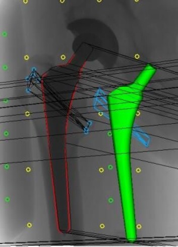 Bildet viser hvordan legene gjennomfører 3D-analyser på røntgenbilder av et hofteimplantat. På røntgenbildet er hofteprotesen markert med rødt, mens den grønne delen er en 3D-modell av protesen. Metallkulene i pasientens knokler (blå sirkler) tjener som markører for om protesen har flyttet seg eller blitt slitt. De grønne og gule kulene er markører som befinner seg i en boks under pasienten og i selve røntgenapparatet. (Foto: (Illustrasjon: Maiken Stilling)) Bildet viser hvordan legene gjennomfører 3D-analyser på røntgenbilder av et hofteimplantat. På røntgenbildet er hofteprotesen markert med rødt, mens den grønne delen er en 3D-modell av protesen. Metallkulene i pasientens knokler (blå sirkler) tjener som markører for om protesen har flyttet seg eller blitt slitt. De grønne og gule kulene er markører som befinner seg i en boks under pasienten og i selve røntgenapparatet. (Foto: (Illustrasjon: Maiken Stilling))