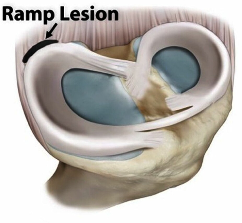 This is what a “ramp lesion” looks like: the meniscus is torn away from its attachment in the joint capsule.