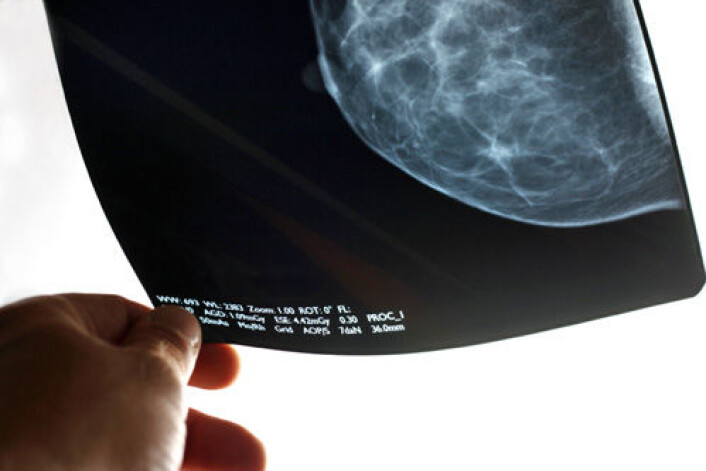 Forskere er uenige om effekten av screening med mammografi for brystkreft. (Foto: iStockphoto) Forskere er uenige om effekten av screening med mammografi for brystkreft. (Foto: iStockphoto)