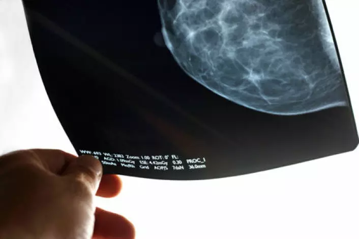 Forskere er uenige om effekten av screening med mammografi for brystkreft. (Foto: iStockphoto)