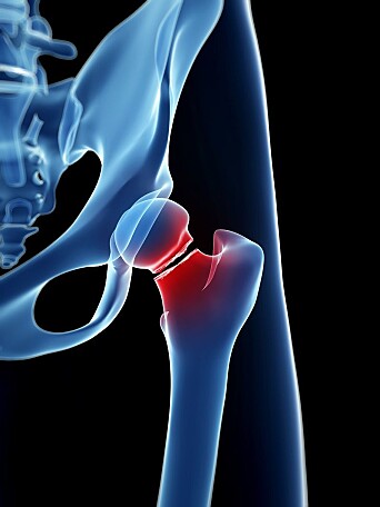 Many of the patients who are operated on for hip fractures are older, and mortality is high. Many of the patients who are operated on for hip fractures are older, and mortality is high.