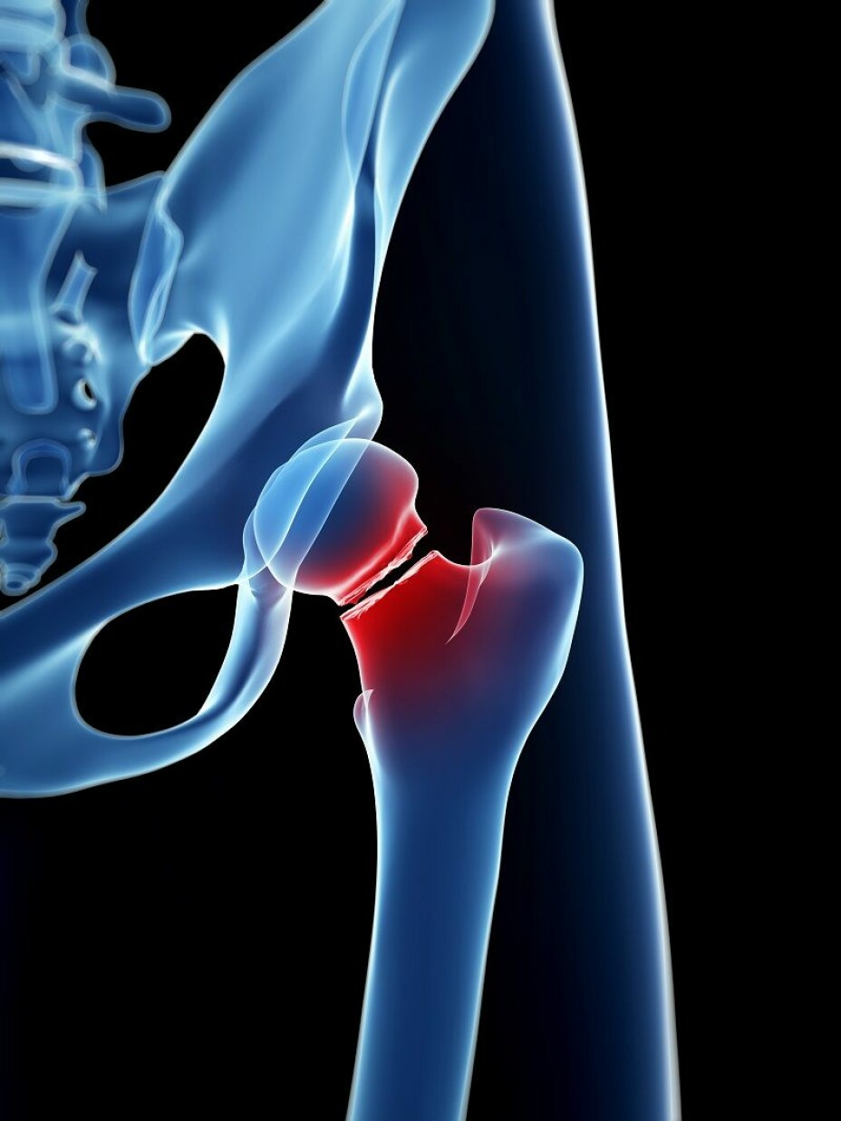 Many of the patients who are operated on for hip fractures are older, and mortality is high.