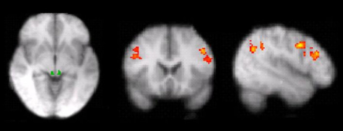 fMRI-bilder av hjernen under smerteforsøk. (Foto: Siri Leknes) fMRI-bilder av hjernen under smerteforsøk. (Foto: Siri Leknes)