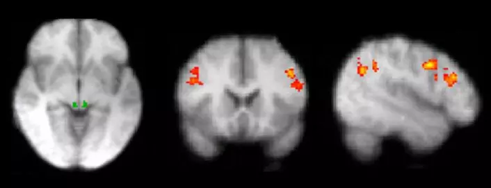 fMRI-bilder av hjernen under smerteforsøk. (Foto: Siri Leknes)