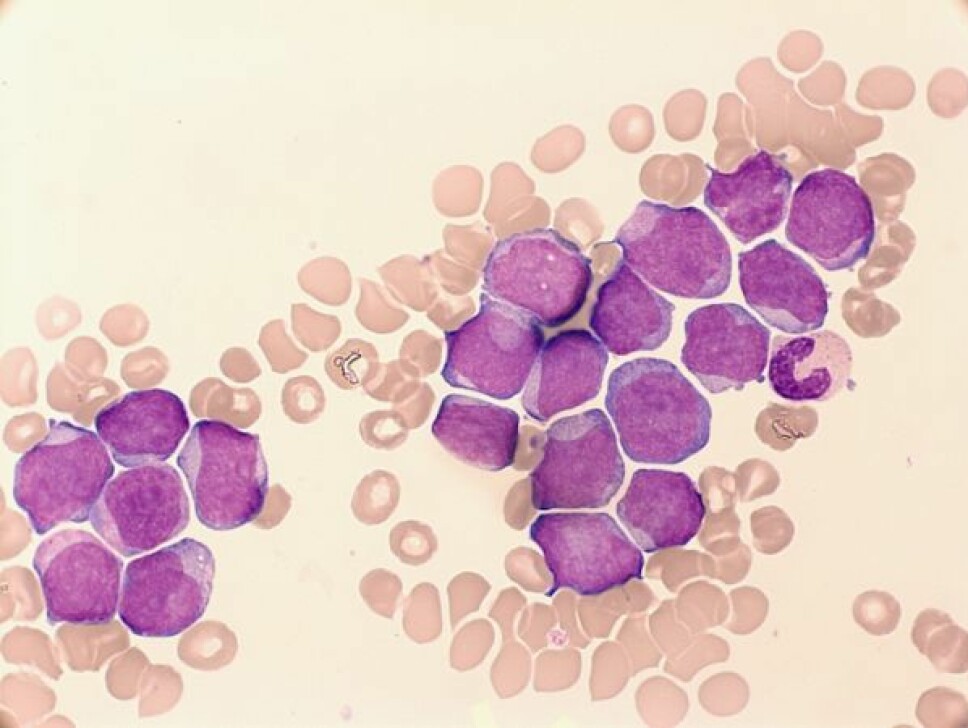 AML patient sample showing a subset of aberrant cells (purple) among normal population (pink).