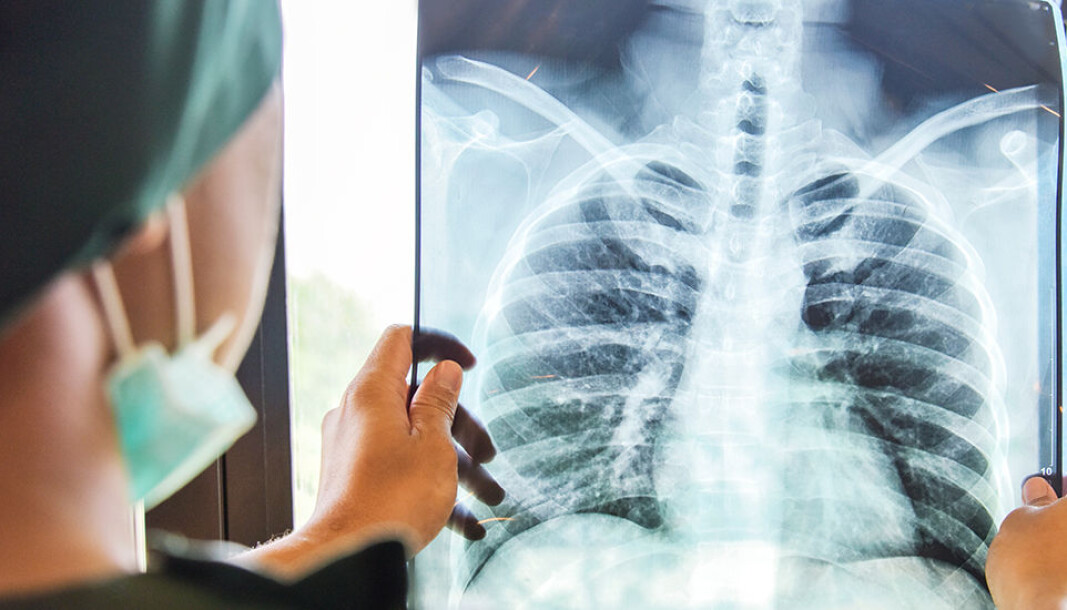 A new risk prediction method can reduce the number of people who are subjected to unnecessary CT scans to screen for lung cancer. At the same time the method ensures that those with the highest risk are identified so that they can receive the necessary treatment. A new risk prediction method can reduce the number of people who are subjected to unnecessary CT scans to screen for lung cancer. At the same time the method ensures that those with the highest risk are identified so that they can receive the necessary treatment.