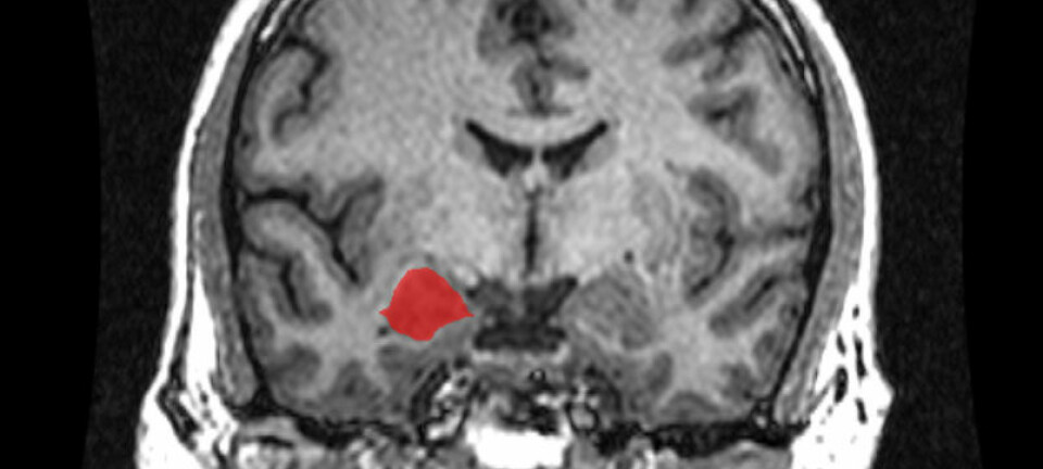 Amygdala (rødmerket område), sett i MRI-hjerneskanning bakfra. (Foto:Amber Rieder, Jenna Traynor, Geoffrey B Hall, Creative Commons)