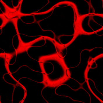 En aneurisme er en sekkformet utposning av veggen i et blodkar. Skjer utposningen på hovedpulsåren, aorta, kalles den en aortaaneurisme. (Foto: Colourbox) En aneurisme er en sekkformet utposning av veggen i et blodkar. Skjer utposningen på hovedpulsåren, aorta, kalles den en aortaaneurisme. (Foto: Colourbox)