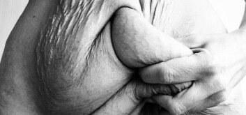 Fedmekirurgi gir hurtig vekttap, men har sin pris. Huden som har blitt strukket og tøyd i alle år blir igjen – i overflod. (Foto: Tine Dyrkorn) Fedmekirurgi gir hurtig vekttap, men har sin pris. Huden som har blitt strukket og tøyd i alle år blir igjen – i overflod. (Foto: Tine Dyrkorn)