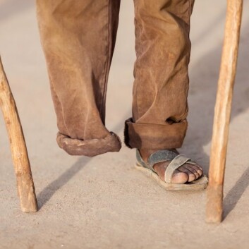 Hjernen oppfatter ikke alltid at en fot er borte, og fortsetter å sende signaler til den manglende kroppsdelen. (Foto: iStockphoto) Hjernen oppfatter ikke alltid at en fot er borte, og fortsetter å sende signaler til den manglende kroppsdelen. (Foto: iStockphoto)