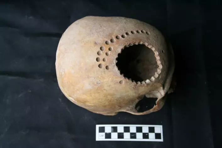 Denne hodeskallen fra Peru viser at hvordan kirurgi på kraniet ble utøvd for ett tusen år siden. Teknikken som kalles trepanasjon kan utføres ved å bore en rekke hull i hodeskallen. (Foto: Danielle Kurin)