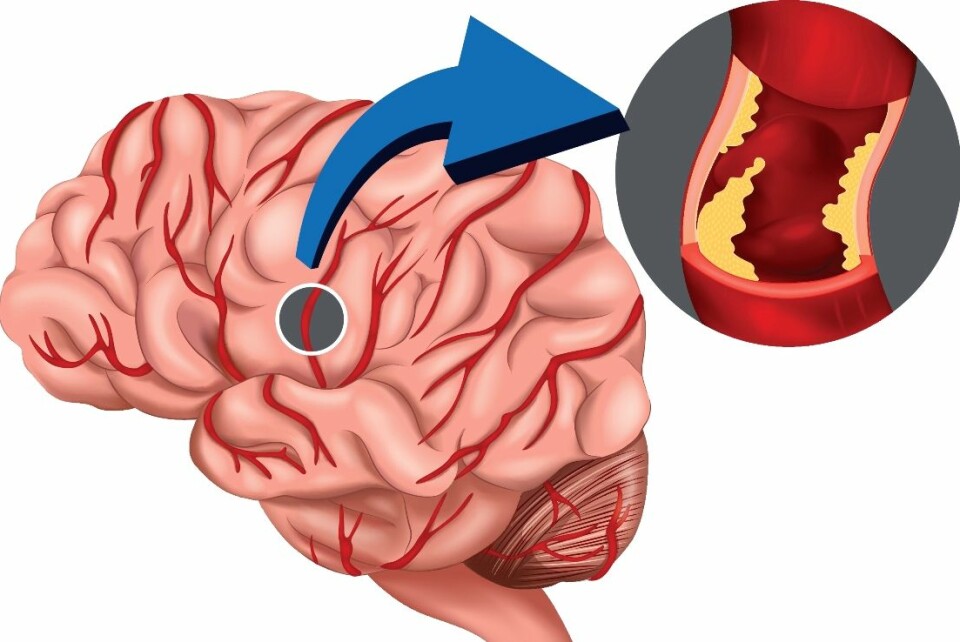 En hjerneblødning oppstår fordi det går hull på et lite kar i hjernen. (Foto: Colourbox)