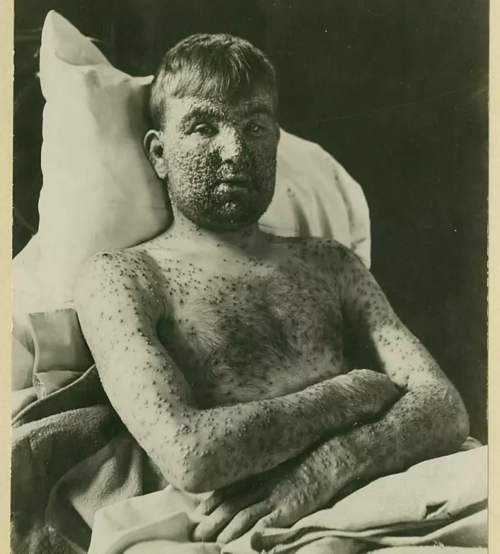 Pasienten fikk som regel flest kopper på ekstremitetene - i ansiktet og på armer og bein. (Foto: Oslo universitetssykehus Ullevål)