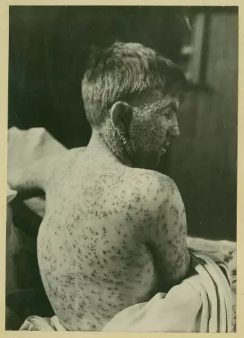 Særlig barn ble hardt angrepet av variola major. (Foto: Oslo universitetssykehus Ullevål)
