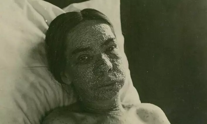 Infeksjoner og væskeansamlinger under huden i ansiktet kunne gjøre pasienten ugjenkjennelig. (Foto: Oslo universitetssykehus Ullevål)