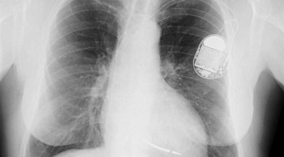 Røntgenbilde av pacemaker. (Foto: Wikimedia Commons, se lisens)