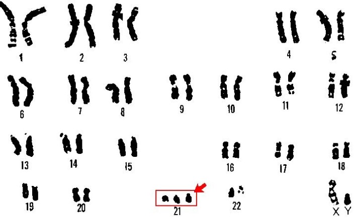 Kromosomene til en person med Downs syndrom. Se de tre kopiene av kromosom 21, markert med rødt. Personer uten Downs syndrom har bare to slike. (Foto: (Bilde: U.S. Department of Energy Human Genome Program)) Kromosomene til en person med Downs syndrom. Se de tre kopiene av kromosom 21, markert med rødt. Personer uten Downs syndrom har bare to slike. (Foto: (Bilde: U.S. Department of Energy Human Genome Program))