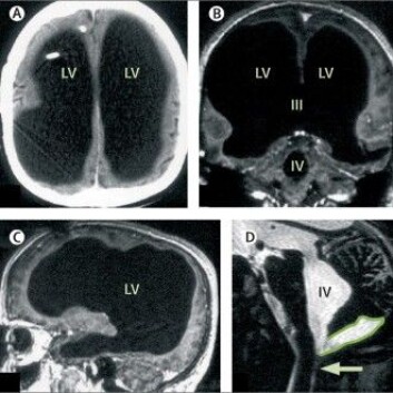 (Foto: Bilde fra The Lancet-artikkelen, Brain of a white-collar worker) (Foto: Bilde fra The Lancet-artikkelen, Brain of a white-collar worker)