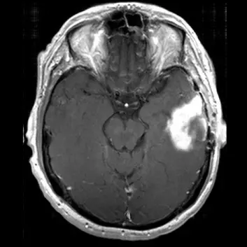 Et bilde av en ondartet hjernesvulst tatt med MR. (Foto: Kyrre E. Emblem)