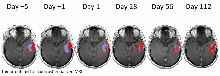 Forskerne kan tydelig se hvordan hjernesvulsten responderer på medisiner. (Foto: (Illustrasjon: Kyrre E. Emblem))