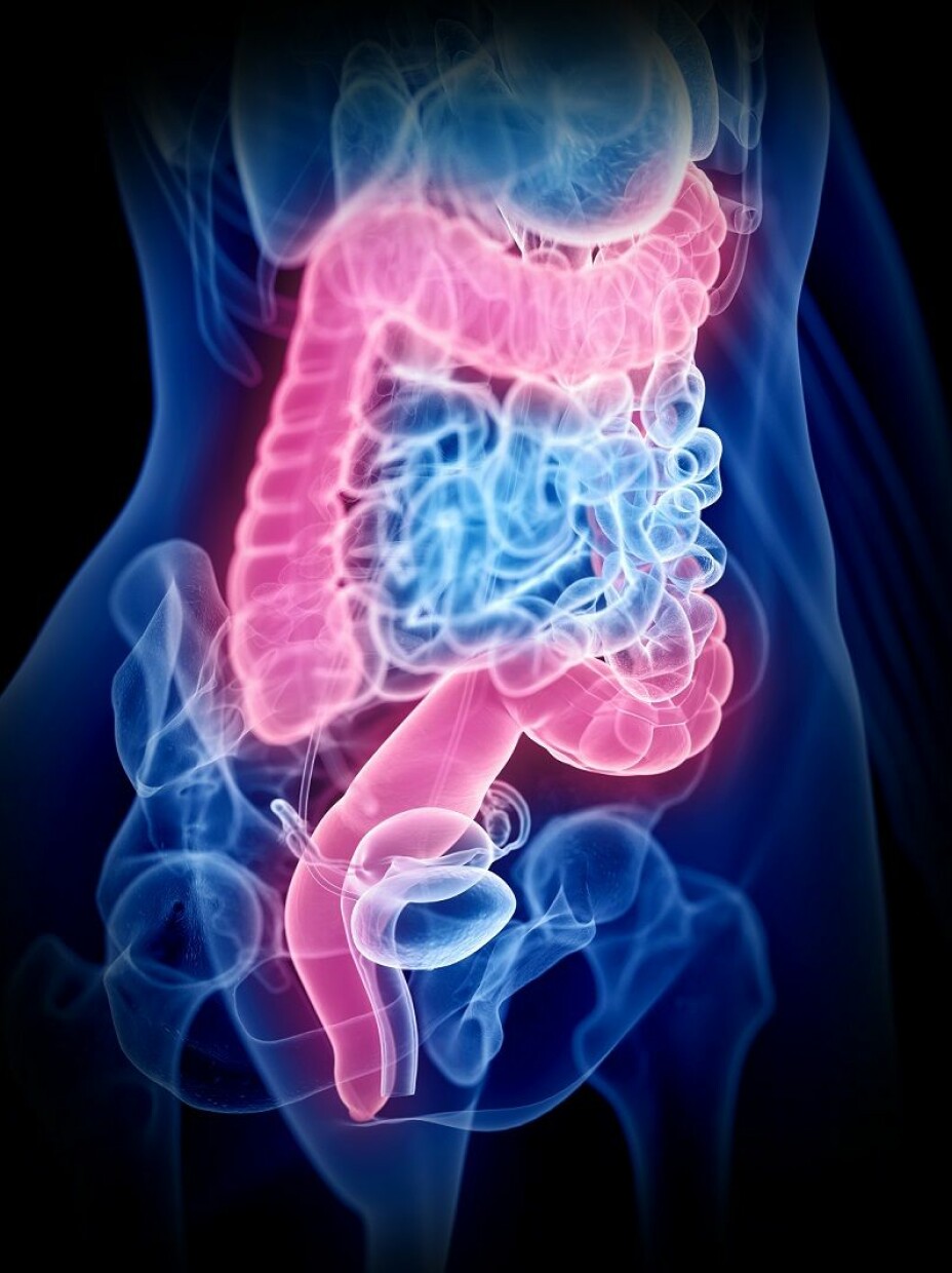Chronic intestinal inflammation can affect all parts of the gastrointestinal tract, often between the small intestine and the large intestine.