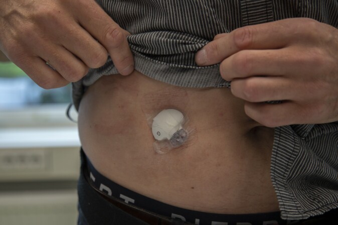 En liten sensor på magen sender kontinuerlig data fra målinger av blodsukkeret. En liten sensor på magen sender kontinuerlig data fra målinger av blodsukkeret.