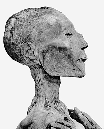 Det mumifiserte ansiktet til Ramses V har koppelignende prikker i ansiktet. Det mumifiserte ansiktet til Ramses V har koppelignende prikker i ansiktet.