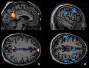 "Figuren syner skilnad mellom kontrollgruppa og personar med MCI-diagnosen. fMRI-karta til venstre viser regionar knytt til redusert aktivering i kviletilstand (default mode). Til høgre ser vi område som er del av eit nettverk relatert til merksemd, og som også viser minka aktivitet hjå pasientar." "Figuren syner skilnad mellom kontrollgruppa og personar med MCI-diagnosen. fMRI-karta til venstre viser regionar knytt til redusert aktivering i kviletilstand (default mode). Til høgre ser vi område som er del av eit nettverk relatert til merksemd, og som også viser minka aktivitet hjå pasientar."