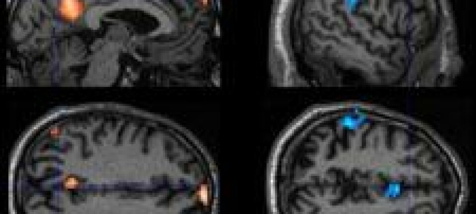 'Figuren syner skilnad mellom kontrollgruppa og personar med MCI-diagnosen. fMRI-karta til venstre viser regionar knytt til redusert aktivering i kviletilstand (default mode). Til høgre ser vi område som er del av eit nettverk relatert til merksemd, og som også viser minka aktivitet hjå pasientar.'