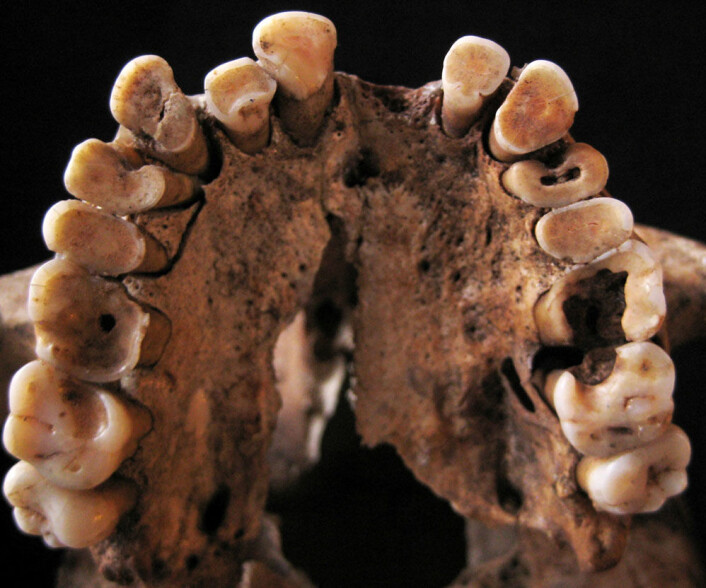 Dette mennesket hadde flere hull og andre tannproblemer, da det levde for mellom 14 000 og 15 000 år siden. Skjelettet ble funnet i Taforalt-hulen i Marokko. (Foto: Isabelle De Groote) Dette mennesket hadde flere hull og andre tannproblemer, da det levde for mellom 14 000 og 15 000 år siden. Skjelettet ble funnet i Taforalt-hulen i Marokko. (Foto: Isabelle De Groote)