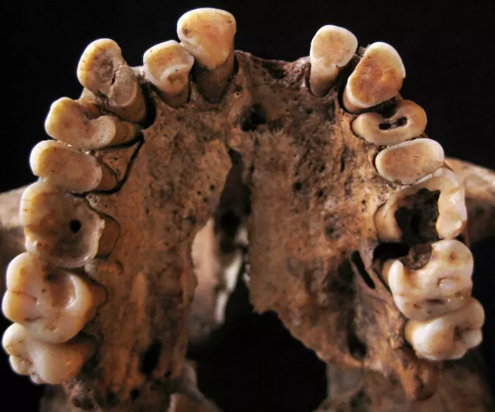 Dette mennesket hadde flere hull og andre tannproblemer, da det levde for mellom 14 000 og 15 000 år siden. Skjelettet ble funnet i Taforalt-hulen i Marokko. (Foto: Isabelle De Groote)