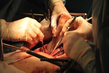En ødelagt lever blir erstattet med en frisk. PSC har i en årrekke vært den vanligste årsaken til levertransplantasjoner her i landet. (Foto: Ram Gupta, OUS) En ødelagt lever blir erstattet med en frisk. PSC har i en årrekke vært den vanligste årsaken til levertransplantasjoner her i landet. (Foto: Ram Gupta, OUS)