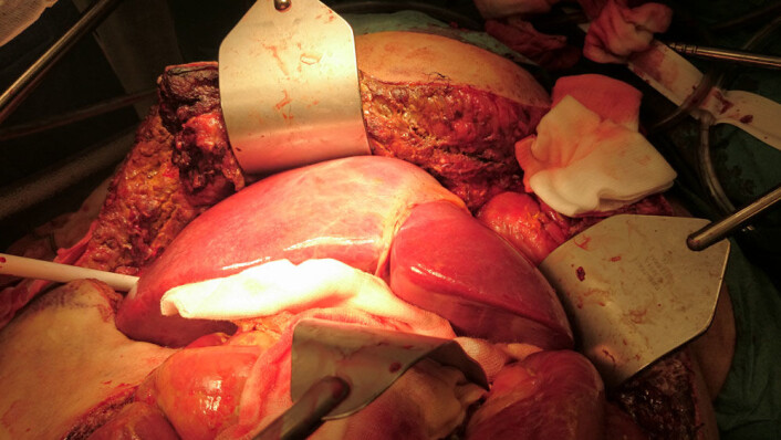 Donorlever som blir transplantert inn i kreftpasient. (Foto: Oslo Universitetssykehus) Donorlever som blir transplantert inn i kreftpasient. (Foto: Oslo Universitetssykehus)