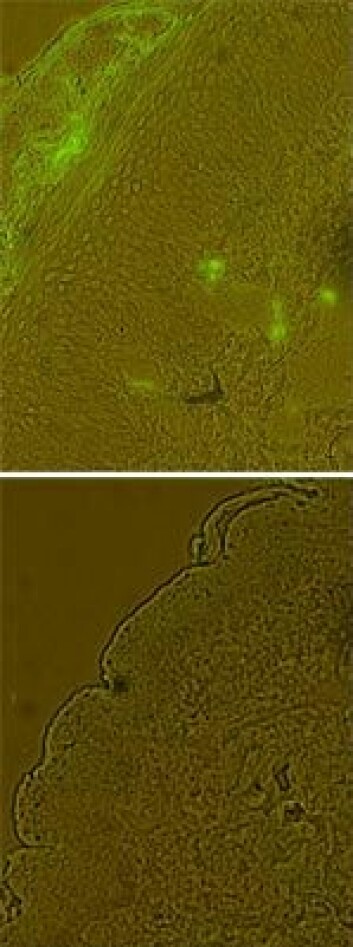 "Øverst ser vi et røntgenbilde tatt med fluoriserende lys. De grønne flekkene viser celler som produserer proteinet som professor Iversen tror er skyld i betennelsessykdommen. Det nederste bildet viser det samme hudområdet etter behandlingen. Betennelsen har avtatt." (Foto: Gemeni.no)