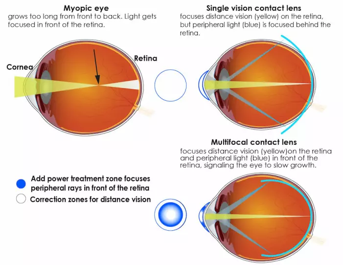 Her kan du se en illustrasjon av hvordan lyset fokuseres i øyet for nærsynte, og hvordan ulike kontaktlinser kan motvirke det.