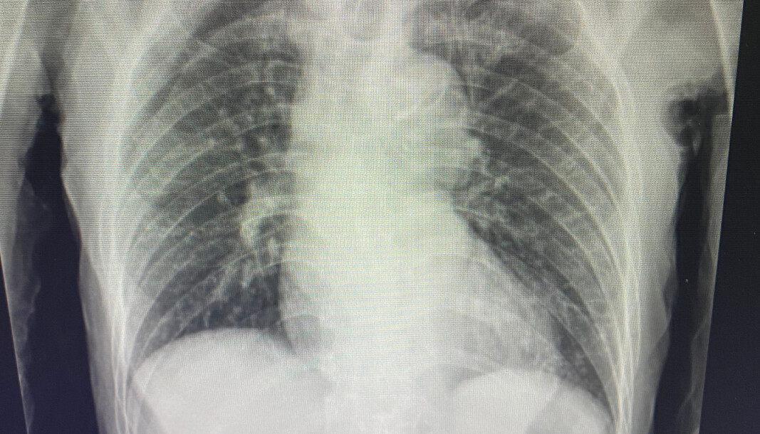 X-ray showing possible tuberculosis infection. A research team at NTNU have now managed to film the process of how the tuberculosis bacterium kills its host cell. X-ray showing possible tuberculosis infection. A research team at NTNU have now managed to film the process of how the tuberculosis bacterium kills its host cell.