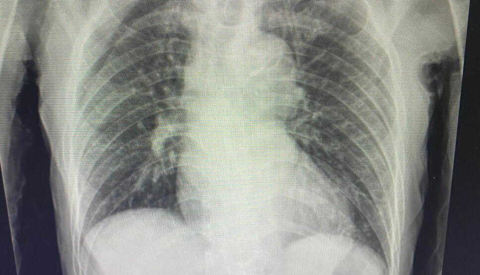 X-ray showing possible tuberculosis infection. A research team at NTNU have now managed to film the process of how the tuberculosis bacterium kills its host cell.