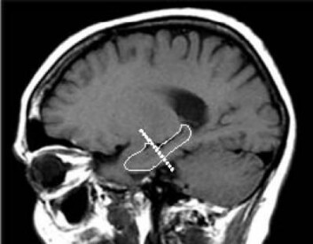 Plasseringen til hippocampus i hjernen. (Foto: Columbia University Medical Center)