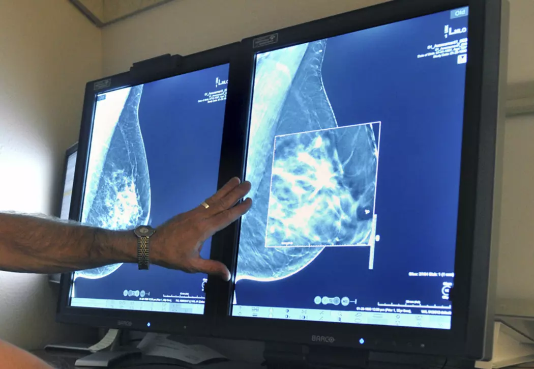 Det kan være krevende for en røntgenlege å tolke noen mammogrammer. Kunstig intelligens kan hjelpe dem i framtiden.